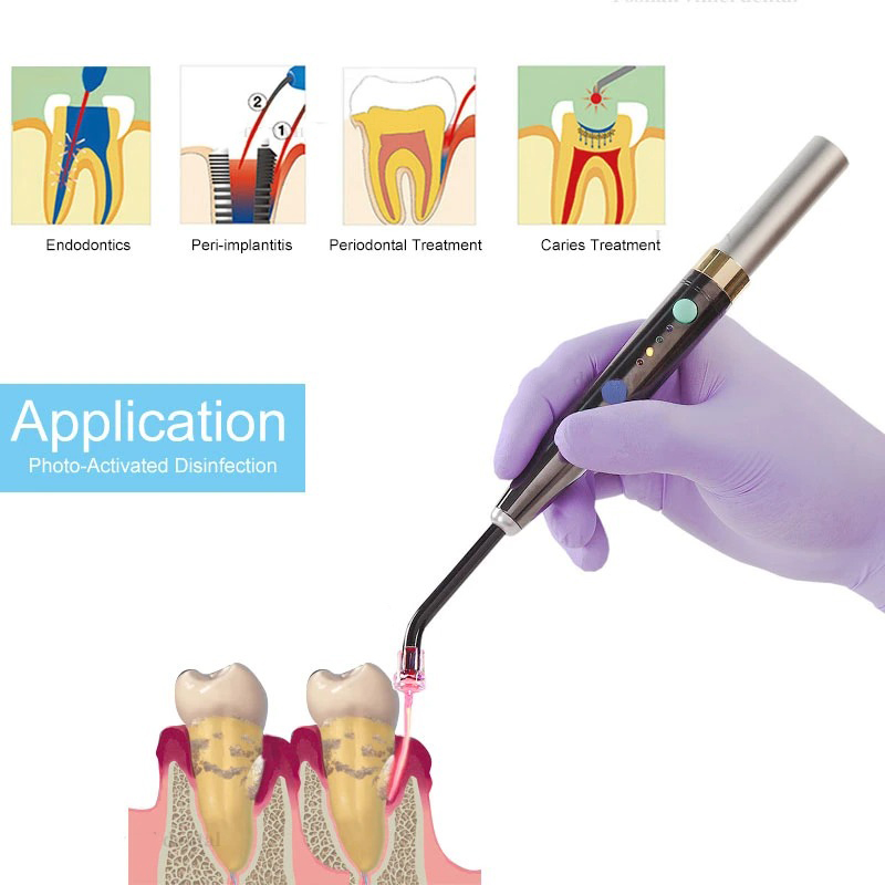 Sistema Laser Dentale Wireless - Diode Laser Module recensione e prezzo